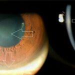 Kayser-Fleischer ring: slit-lamp photographs with arrows marking a golden-brown ring of copper deposition at the corneal periphery (Descemet membrane) in a patient with Wilson disease