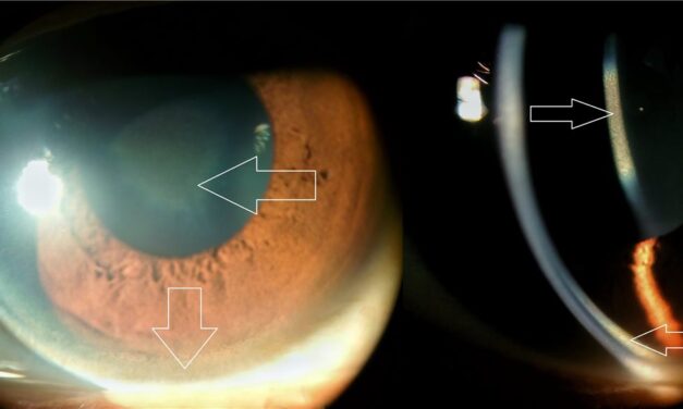 Kayser-Fleischer Ring: The Eye Sign That Points to the Liver