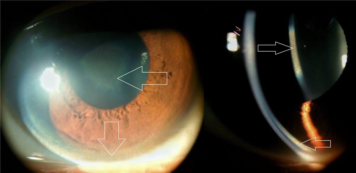 Kayser-Fleischer Ring: The Eye Sign That Points to the Liver