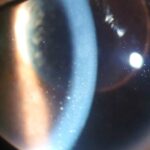Keratic precipitates: fine white cellular deposits on the corneal endothelium in anterior uveitis