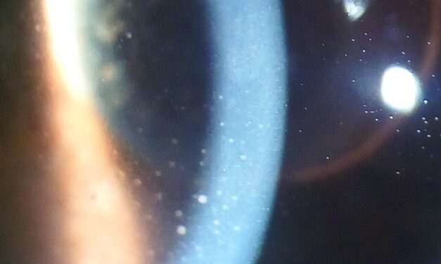 Keratic Precipitates: Reading the Uveitis Exam at the Slit Lamp