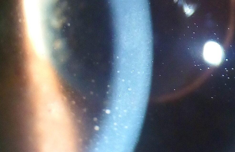Keratic Precipitates: Reading the Uveitis Exam at the Slit Lamp