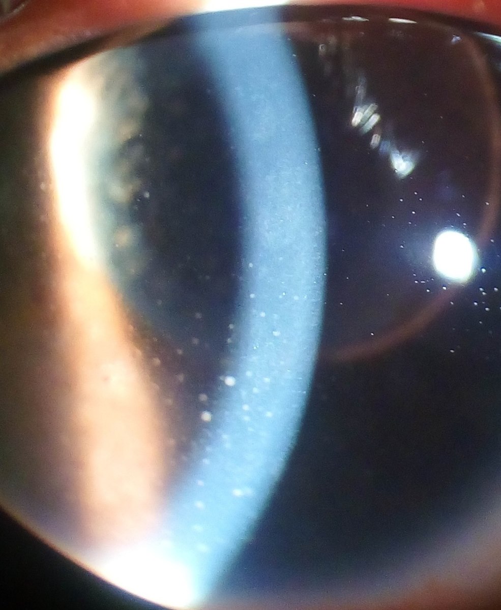 Keratic precipitates: fine white cellular deposits on the corneal endothelium in anterior uveitis
