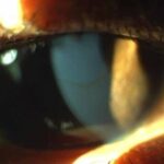 Keratoconus on slit-lamp examination showing conical corneal protrusion and stromal thinning