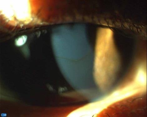 Keratoconus: Reading the Early Signs Before the Cornea Gives Way