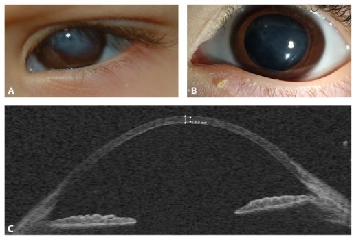 Keratoglobus Keratoglobus in brittle cornea syndrome: globular, diffusely thinned cornea with peripheral steepening