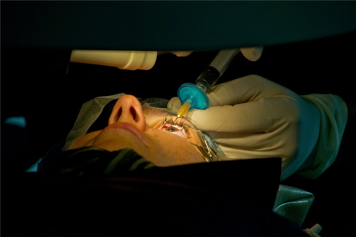 LASIK Refractive Surgery - procedure in progress LASIK refractive surgery: a close-up view of a patient undergoing laser-assisted in situ keratomileusis, with a lid speculum in place and the eye positioned under the excimer laser