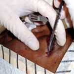 Lateral canthotomy: a clamp crushing the lateral canthus before incision with scissors, the first step of emergency lateral canthotomy and cantholysis for orbital compartment syndrome