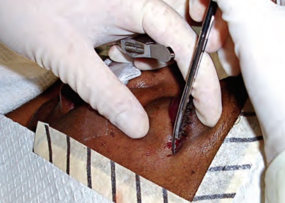 Lateral Canthotomy and Cantholysis: A Procedure That Cannot Wait for Imaging