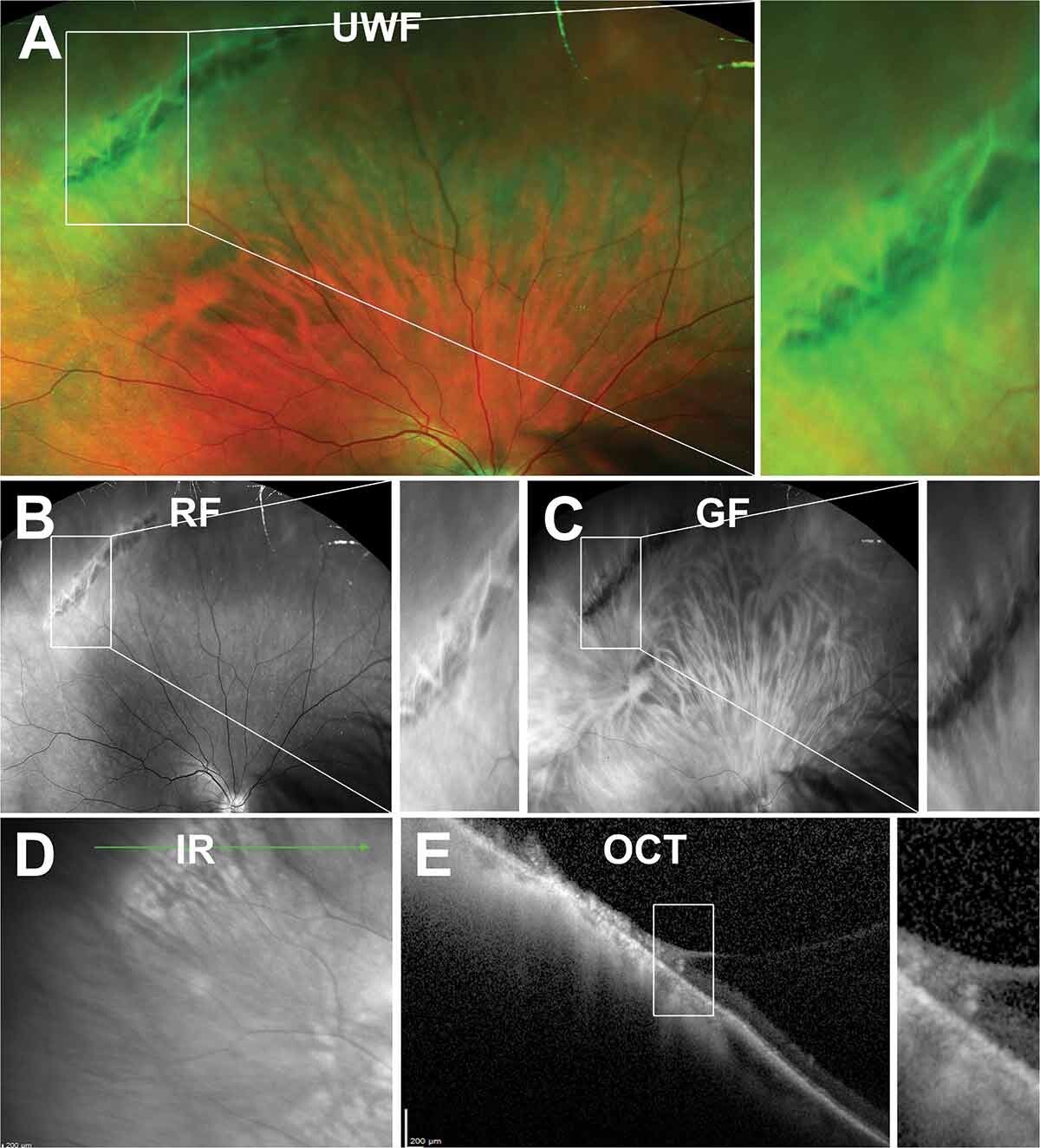 Lattice degeneration: multimodal imaging including ultra-widefield colour photography, red-free and green-free imaging, infrared, and OCT, showing the characteristic criss-crossing lattice pattern in the peripheral retina