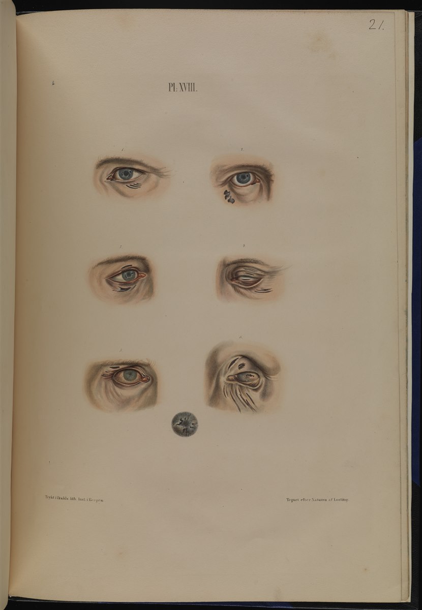 Leprosy (Hansen's disease): chronic ocular and periocular involvement in advanced disease