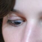 Marcus Gunn jaw-winking syndrome: a young woman demonstrating involuntary elevation of the ptotic eyelid triggered by movement of the jaw