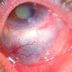 Necrotizing scleritis: a close-up of the eye showing scleral thinning and translucency with visible underlying choroidal vessels following recurrent scleritis, a pattern seen in granulomatosis with polyangiitis