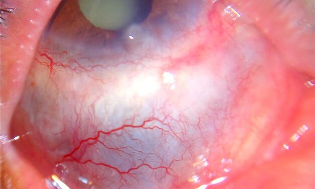 Granulomatosis with Polyangiitis: When Scleritis Is a Systemic Emergency
