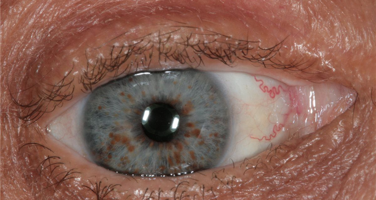 Neurofibromatosis Type 1: When the Iris Confirms the Diagnosis
