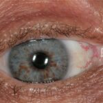 Neurofibromatosis type 1: multiple small, dome-shaped Lisch nodules, aggregates of dendritic melanocytes, scattered across the iris surface