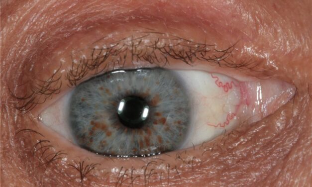 Neurofibromatosis Type 1: When the Iris Confirms the Diagnosis