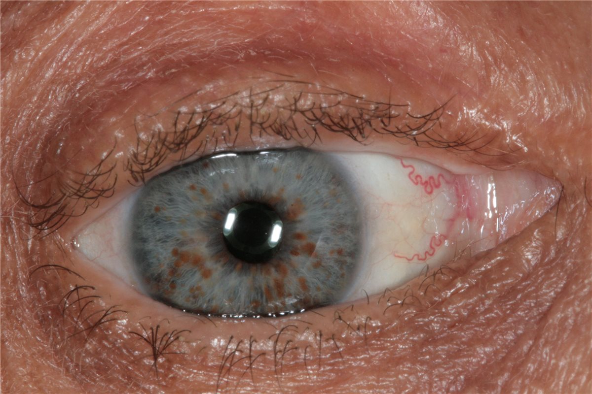 Neurofibromatosis type 1: multiple small, dome-shaped Lisch nodules, aggregates of dendritic melanocytes, scattered across the iris surface