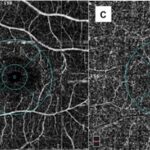 OCT angiography: a colour fundus image alongside segmented en-face angiograms of the superficial capillary plexus, deep capillary plexus and choriocapillaris from the same macular scan