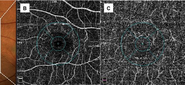 OCT Angiography: Vascular Imaging Without a Dye
