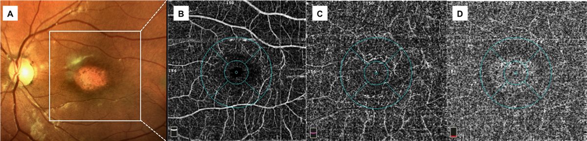 OCT Angiography: Vascular Imaging Without a Dye
