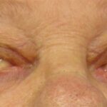 Ocular myasthenia gravis: a patient attempting to open both eyes, showing marked right ptosis with the eye barely open, while the left lid shows compensatory pseudo lid retraction