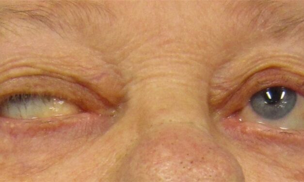Ocular Myasthenia Gravis: The Great Pretender of Neuro-Ophthalmology