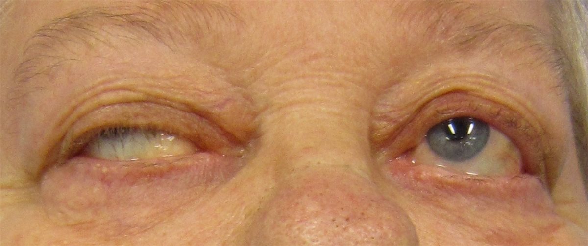 Ocular Myasthenia Gravis: The Great Pretender of Neuro-Ophthalmology
