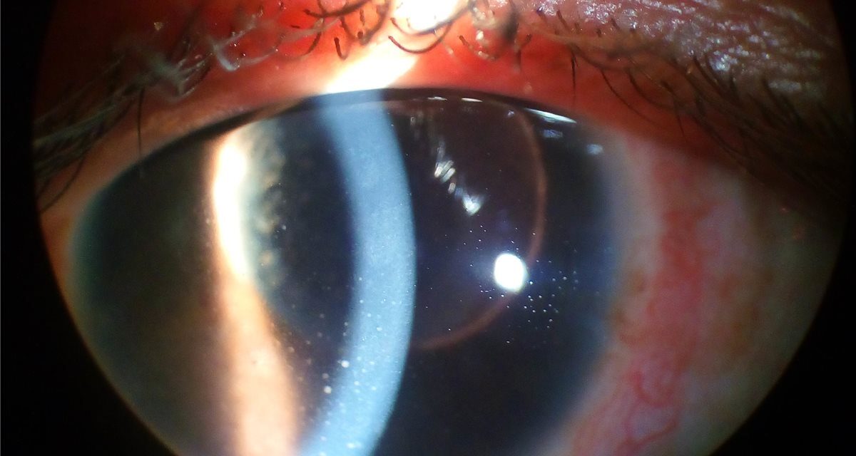 Ocular Sarcoidosis: The Great Mimicker of Uveitis