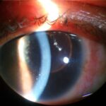 Ocular sarcoidosis: a slit-lamp photograph showing keratic precipitates deposited on the corneal endothelium in a patient with chronic granulomatous uveitis