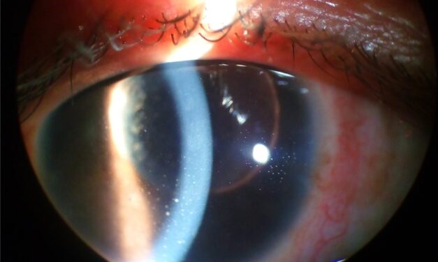 Ocular Sarcoidosis: The Great Mimicker of Uveitis