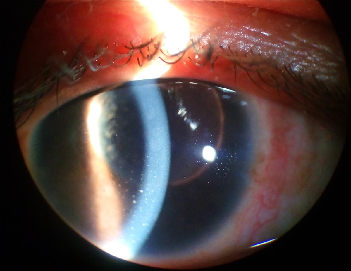 Ocular sarcoidosis: a slit-lamp photograph showing keratic precipitates deposited on the corneal endothelium in a patient with chronic granulomatous uveitis