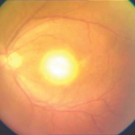 Ocular toxoplasmosis: a fundus photograph showing the classic headlight in fog appearance, a fluffy white focus of active retinochoroiditis with overlying vitreous haze adjacent to an old pigmented chorioretinal scar