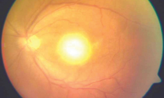 Ocular Toxoplasmosis: The Lesion That Names Itself