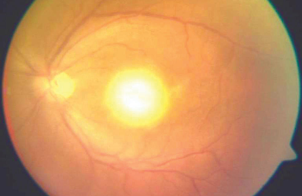 Ocular Toxoplasmosis: The Lesion That Names Itself
