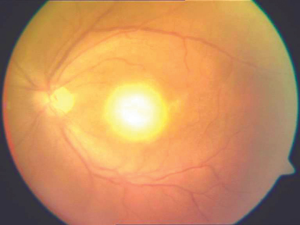Ocular toxoplasmosis: a fundus photograph showing the classic headlight in fog appearance, a fluffy white focus of active retinochoroiditis with overlying vitreous haze adjacent to an old pigmented chorioretinal scar