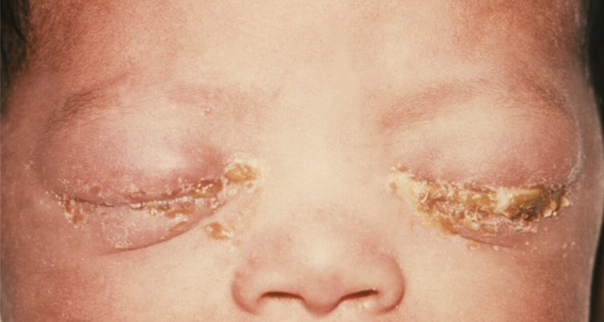 Ophthalmia Neonatorum: The Sticky Eye That Can Perforate a Cornea