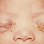 Ophthalmia neonatorum: a newborn with bilateral marked eyelid swelling and copious thick purulent discharge crusting along both lid margins