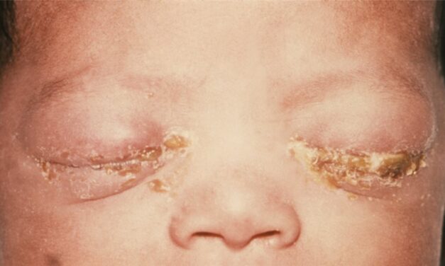 Ophthalmia Neonatorum: The Sticky Eye That Can Perforate a Cornea