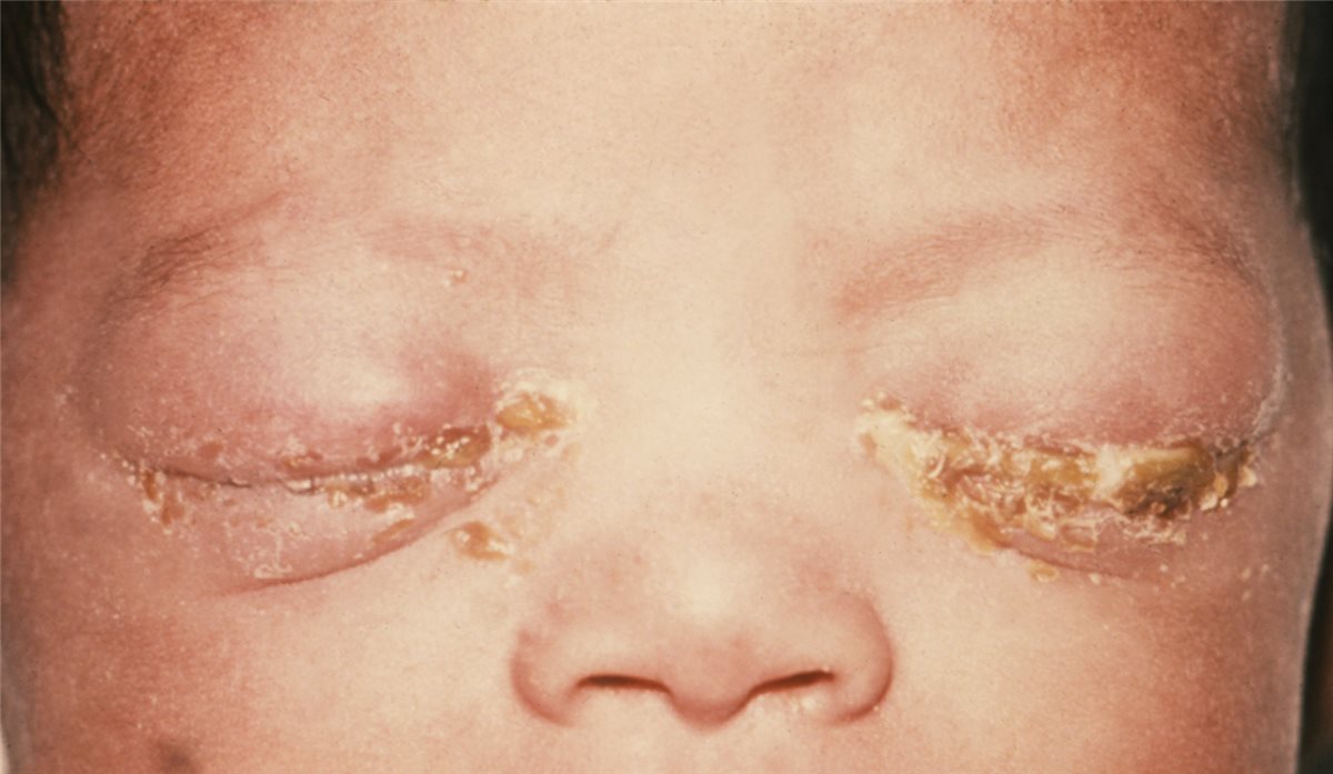 Ophthalmia neonatorum: a newborn with bilateral marked eyelid swelling and copious thick purulent discharge crusting along both lid margins
