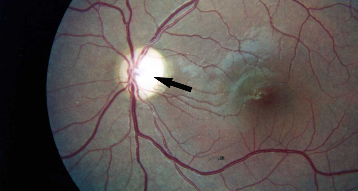 Optic Atrophy: The Pale Disc Is the Scar, Not the Diagnosis