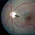 Optic atrophy: fundus photograph showing a chalky white, pale optic disc (arrowed) with clearly defined margins and attenuated surface capillaries