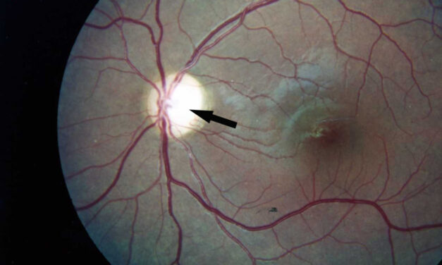 Optic Atrophy: The Pale Disc Is the Scar, Not the Diagnosis