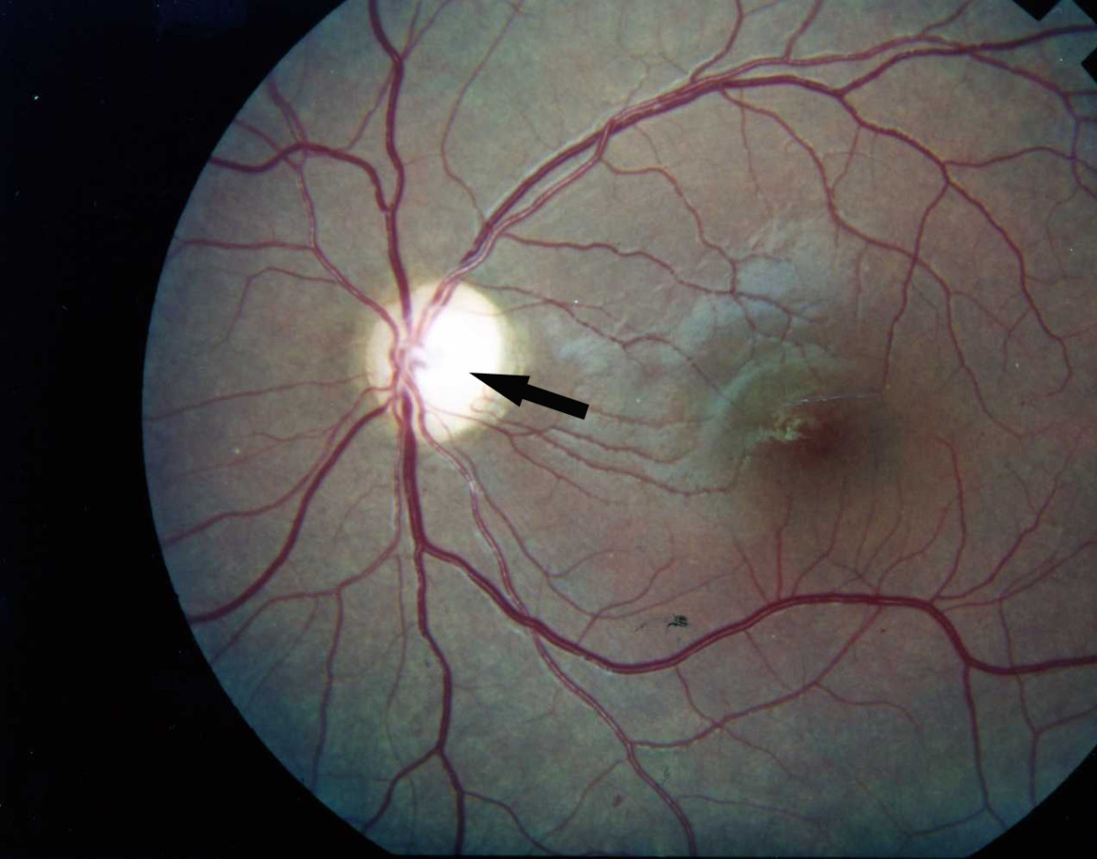 Optic atrophy: fundus photograph showing a chalky white, pale optic disc (arrowed) with clearly defined margins and attenuated surface capillaries