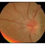 Optic neuritis: a fundus photograph showing a swollen, hyperaemic optic disc with blurred margins and dilated surface vessels, findings of active papillitis