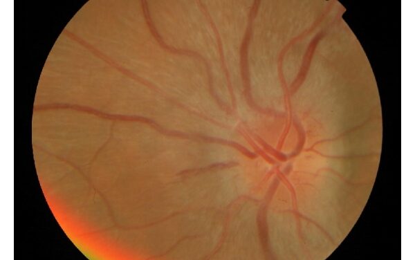 Optic Neuritis: What the MRI Predicts Before the Vision Recovers