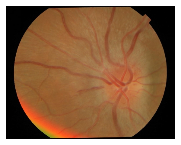 Optic Neuritis: What the MRI Predicts Before the Vision Recovers