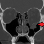Orbital blowout fracture: coronal CT showing a left orbital floor fracture (arrowed) with orbital soft tissue herniating downward into the maxillary sinus