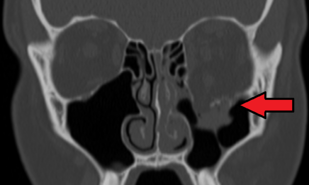 Orbital Blowout Fracture: Which Ones Can Wait and Which Cannot