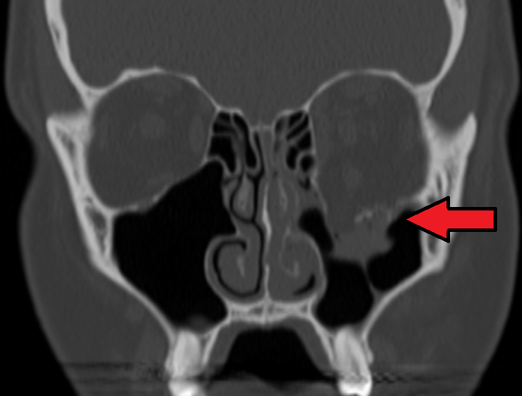 Orbital Blowout Fracture: Which Ones Can Wait and Which Cannot